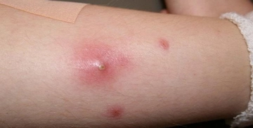 Aslan Pençesi Hastalığı Belirtileri ve Tedavisi Aslan Pençesi Hastalığı Belirtileri ve Tedavisi